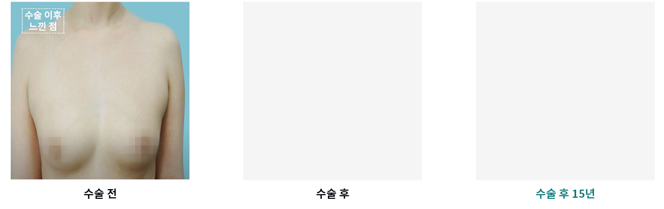 수술 전 수술 후 수술 후 15년 비교